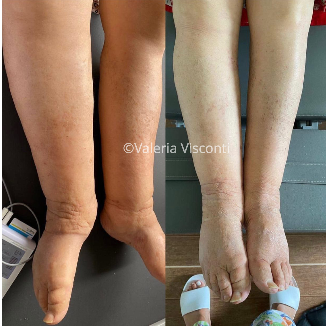 Lymphoedema Reduction in Three Sessions